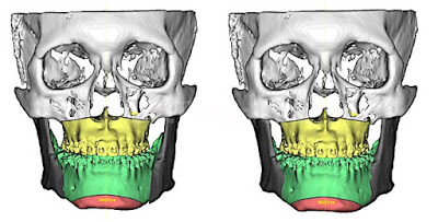 正顎手術完臉會變更圓嗎 Dr 陳瑞鋒的blog 二部曲 凡登整形外科