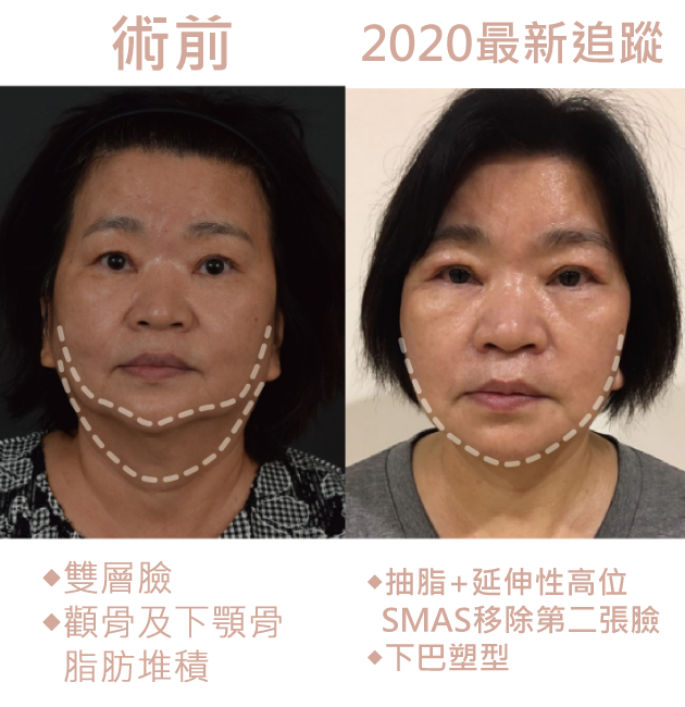 拉皮,拉皮手術,台北拉皮手術,台灣拉皮手術,新竹拉皮手術