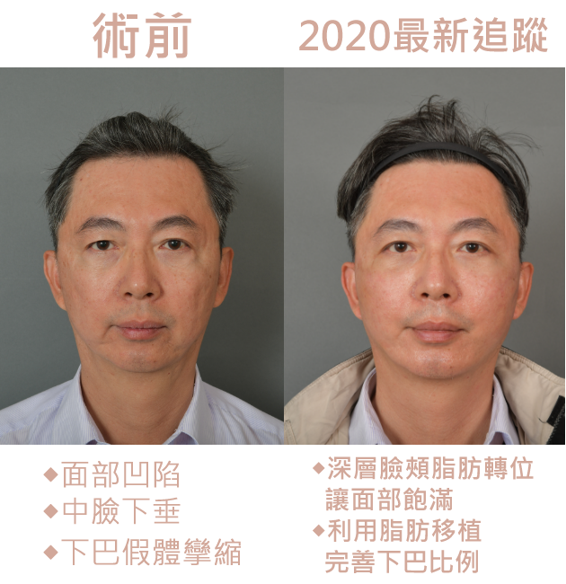 拉皮,拉皮手術,台北拉皮手術,台灣拉皮手術,新竹拉皮手術