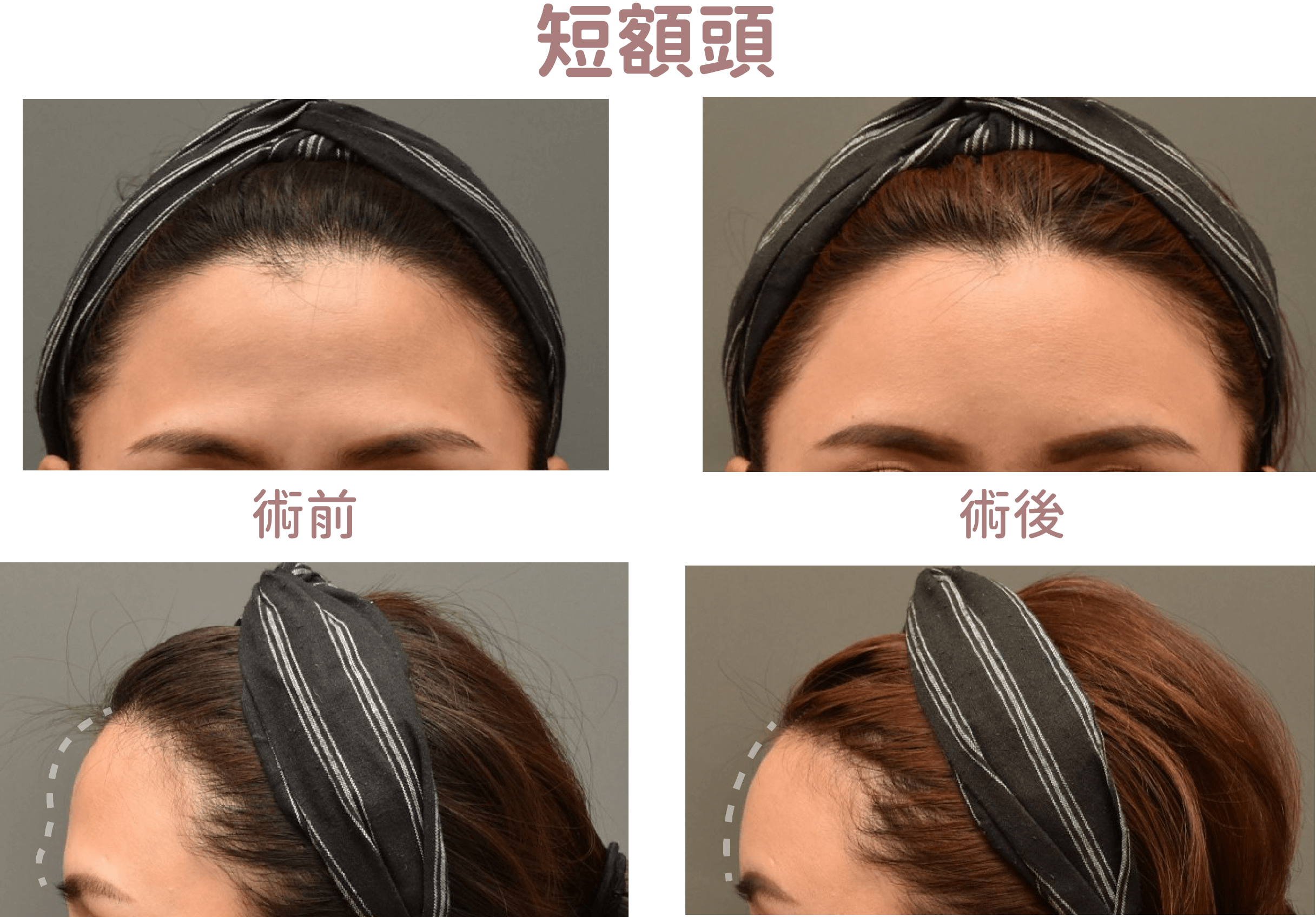 自體脂肪運用,短額頭術前術後對比
