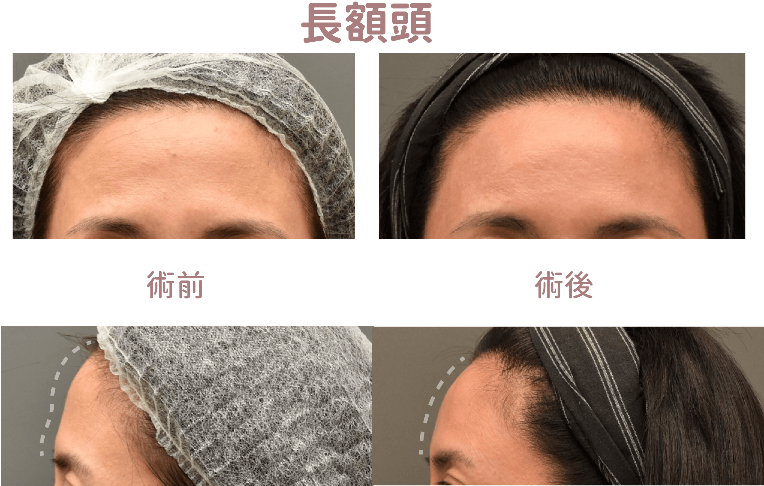 自體脂肪運用,長額頭術前術後對比