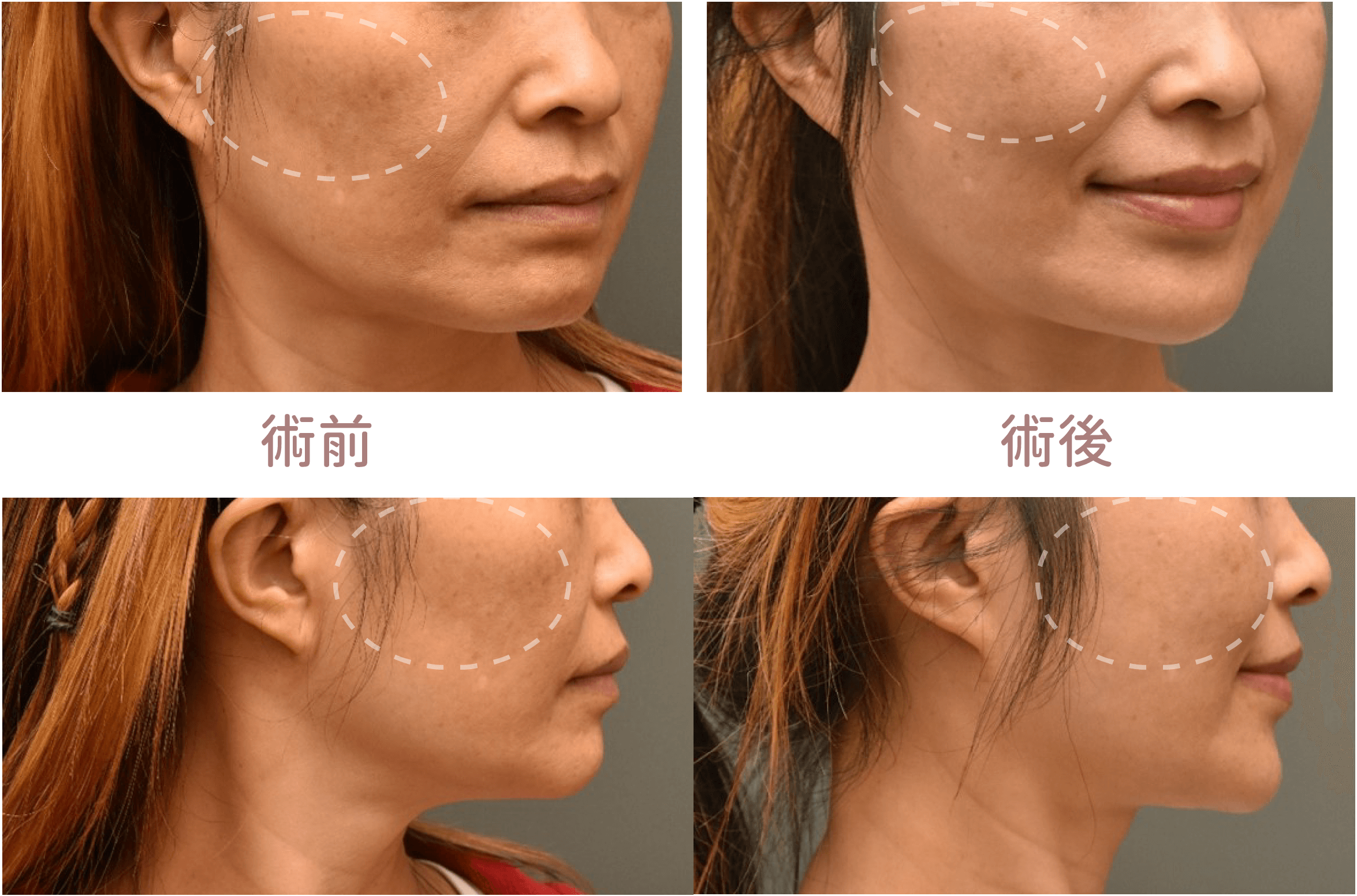 自體脂肪填補淚溝,改善眼袋和顴骨突出