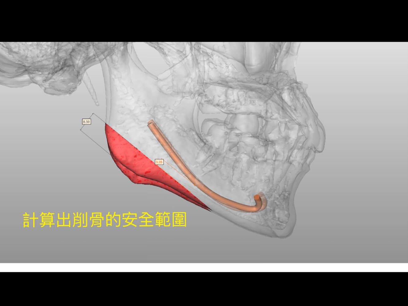 計算出削骨的安全範圍