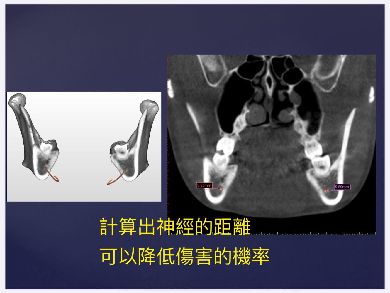 計算出神經的距離可以降低傷害的機率