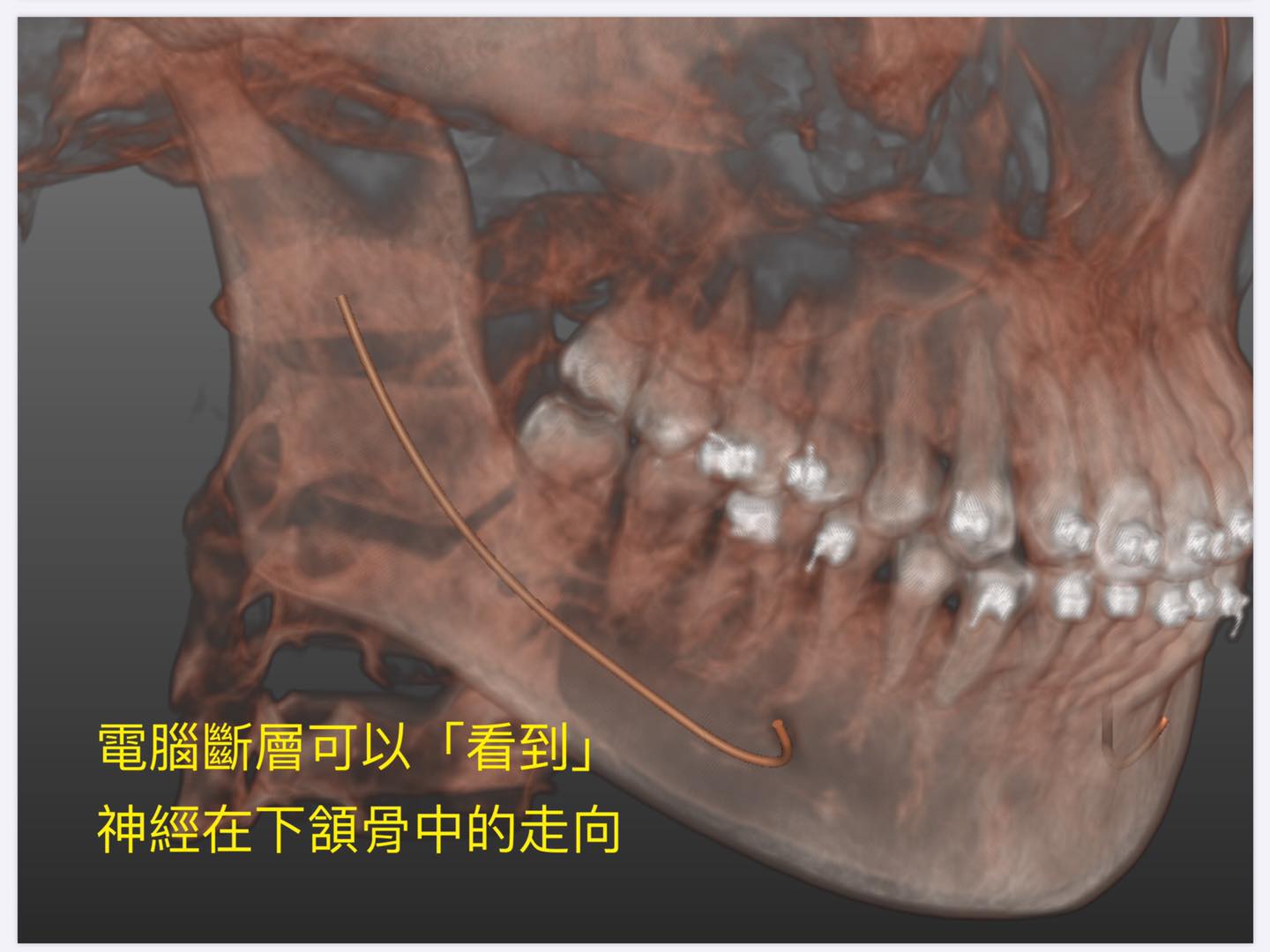 電腦斷層可以看到神經在下頷骨中的走向