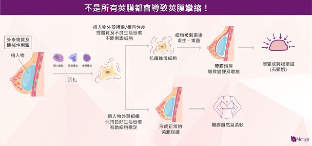 不是所有莢膜都會導致莢膜攣縮！