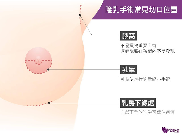 隆乳手術常見切口位置