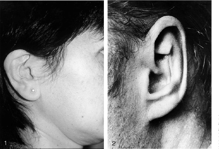 隆鼻手術前耳朵變形
