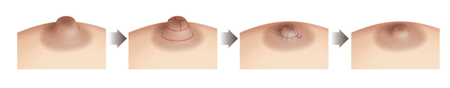 環切搭配楔切，乳頭整形手術流程示意圖