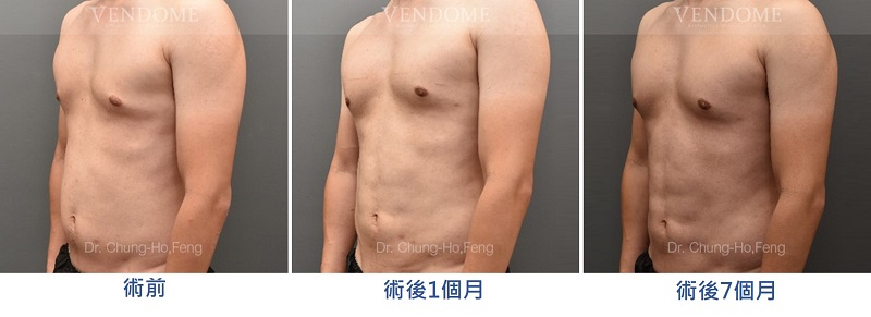 男性腹部抽脂術前術後比較