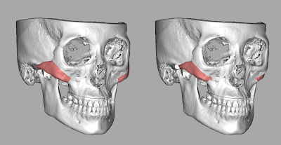 正顎,正顎手術,正颌,顴骨削骨,削骨