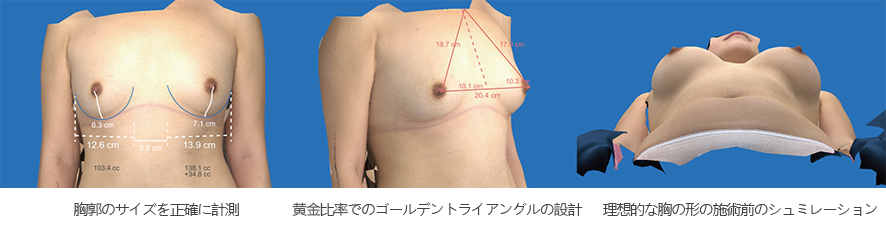 3D模擬評估自體脂肪隆乳