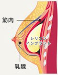 胸大肌下隆乳