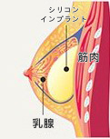 筋膜下隆乳