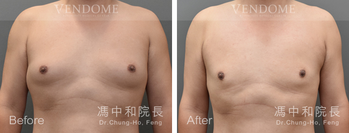 男性女乳,男性女乳手術,抽脂手術,台北男性女乳,新竹男性女乳,台南男性女乳
