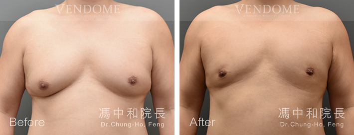 男性女乳,男性女乳手術,抽脂手術,台北男性女乳,新竹男性女乳,台南男性女乳