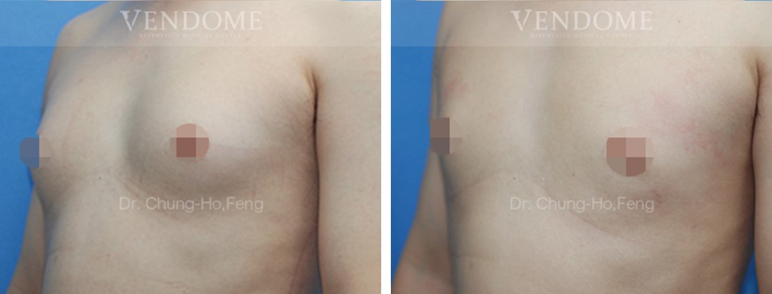 男性女乳,男性女乳手術,抽脂手術,台北男性女乳,新竹男性女乳,台南男性女乳