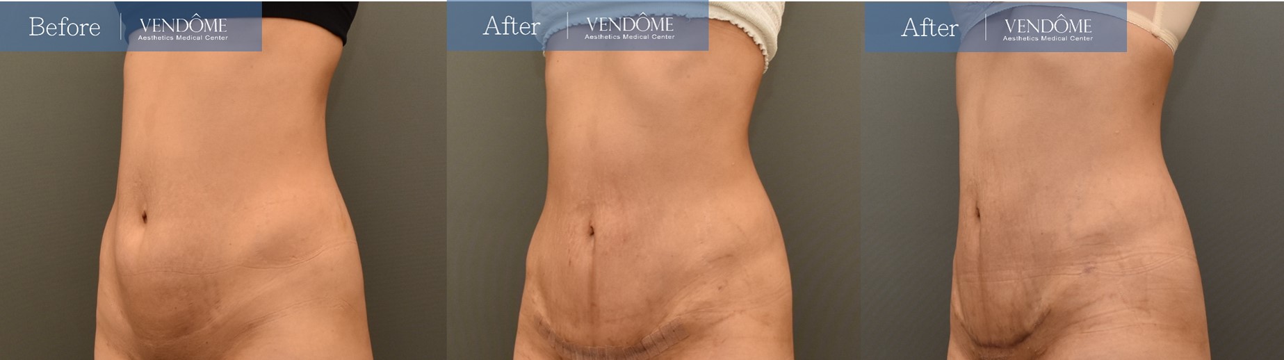 Pearls of Wisdom: Abdominal, Waist and Back Lipo Incisions - Avellanet  Surgical Aesthetics