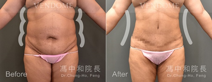 拉皮,腹部拉皮,產後腹部鬆弛,腹拉,馮中和醫師