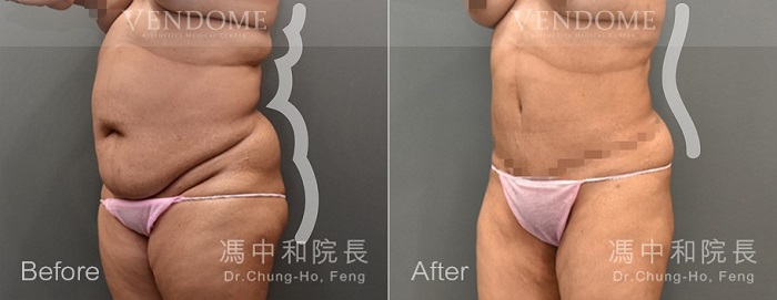拉皮,腹部拉皮,產後腹部鬆弛,腹拉,馮中和醫師