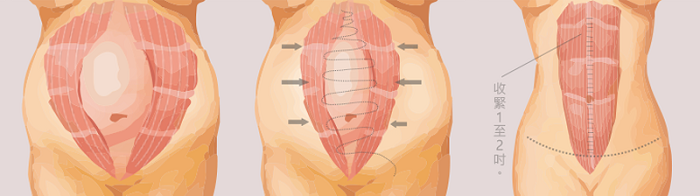 腹部拉皮,拉皮手術,腹拉,台北拉皮手術,新竹拉皮手術,台南拉皮手術