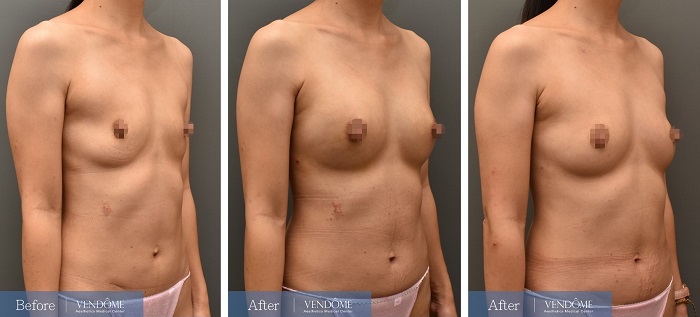 自體脂肪隆乳手術成功案例