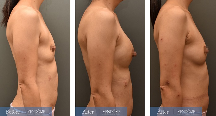 自體脂肪隆乳手術後一個月、手術後五個月