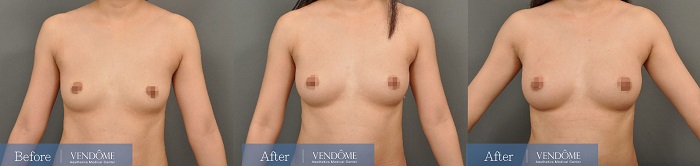 B罩杯產後女性自體脂肪隆乳手術案例
