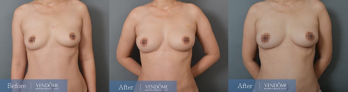 C罩杯產後女性自體脂肪隆乳手術案例