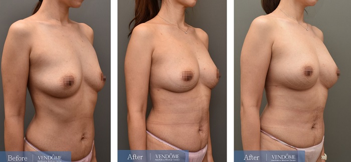 D罩杯產後女性自體脂肪隆乳手術案例