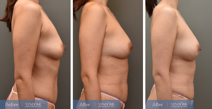 D罩杯產後女性自體脂肪隆乳成效