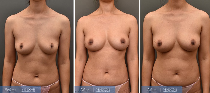 乳房下垂D罩杯自體脂肪隆乳手術案例