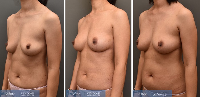 乳房下垂D罩杯自體脂肪隆乳術前術後