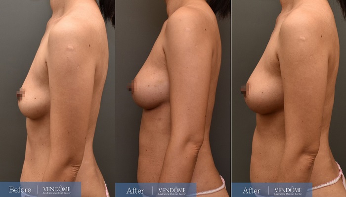 自體脂肪隆乳術前術後 乳房下垂D罩杯