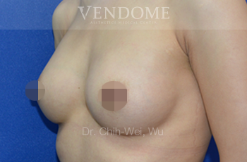 果凍矽膠隆乳術後