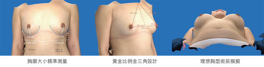 果凍矽膠隆乳 3D模擬精準評估