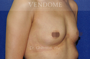 果凍矽膠隆乳術前