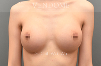 果凍矽膠隆乳術後