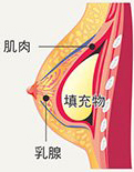 胸大肌下隆乳