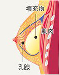 筋膜下隆乳