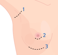 果凍矽膠隆乳 手術切口