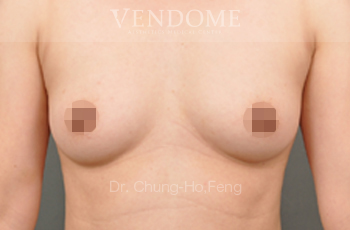 果凍矽膠隆乳,水滴型果凍矽膠隆乳,台北隆乳手術,新竹隆乳手術,台南隆乳手術