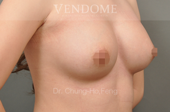 果凍矽膠隆乳,水滴型果凍矽膠隆乳,台北隆乳手術,新竹隆乳手術,台南隆乳手術