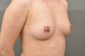 果凍矽膠隆乳,水滴型果凍矽膠隆乳,台北隆乳手術,新竹隆乳手術,台南隆乳手術