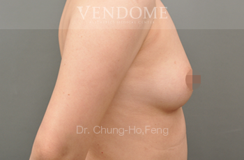 果凍矽膠隆乳,水滴型果凍矽膠隆乳,台北隆乳手術,新竹隆乳手術,台南隆乳手術