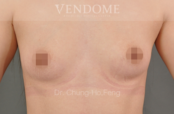果凍矽膠隆乳,水滴型果凍矽膠隆乳,台北隆乳手術,新竹隆乳手術,台南隆乳手術