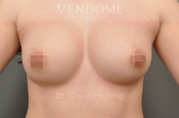 果凍矽膠隆乳,水滴型果凍矽膠隆乳,台北隆乳手術,新竹隆乳手術,台南隆乳手術