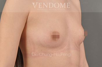 果凍矽膠隆乳,水滴型果凍矽膠隆乳,台北隆乳手術,新竹隆乳手術,台南隆乳手術