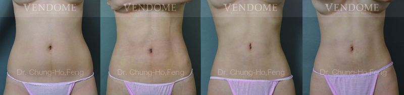 女性腹部抽脂手術案例-1