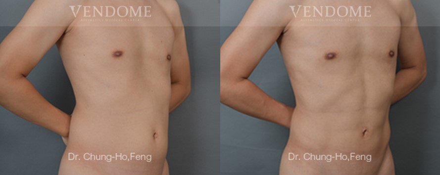 男性腰腹部抽脂人魚線雕塑術前術後側身對比